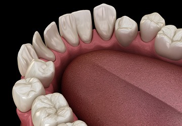 Illustration of spaced-out teeth