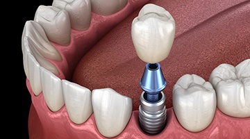 a computer illustration showing the three parts of a dental implant