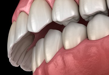 Illustration of an overbite