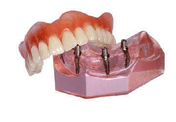 All-on-4 denture model