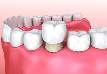 model of dental crown