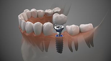 Diagram showing a single tooth dental implant in Melbourne