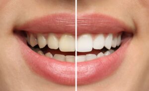 Closeup of woman's smile that's half whitened